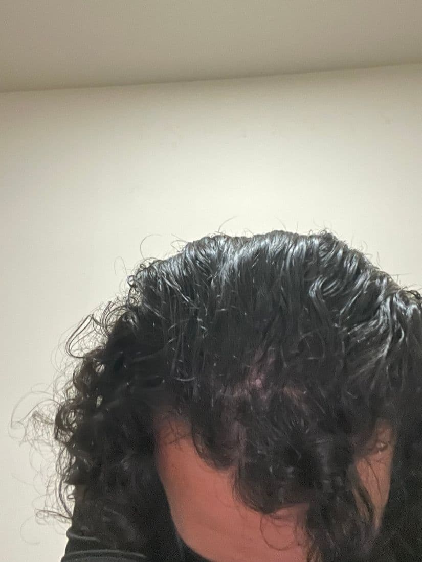 Hair held up to expose the scalp underneath